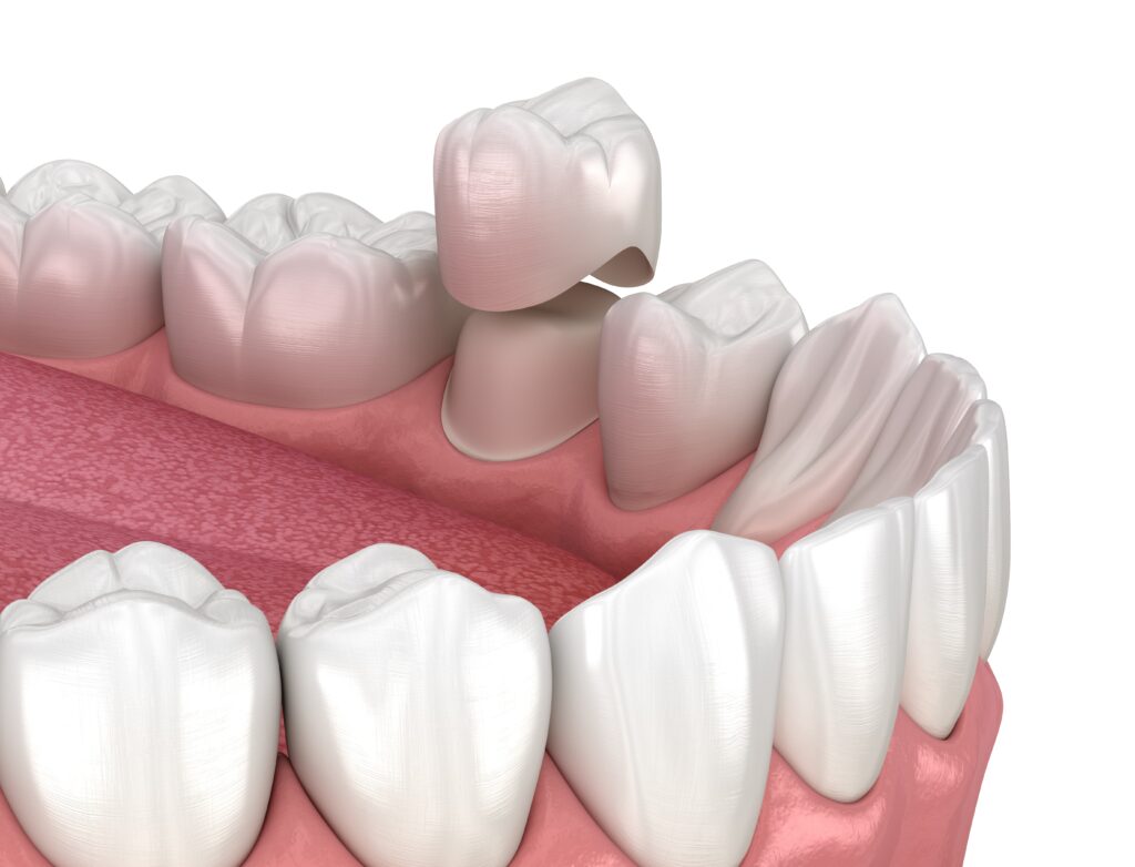dental crowns Crowley